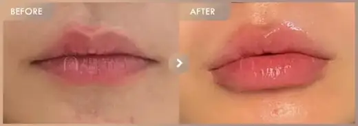 Lip fillers: before-and-after comparison at Newstar Clinic