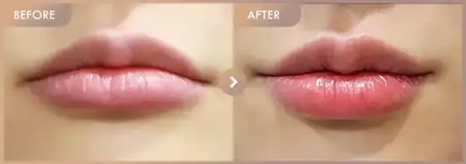 Lip fillers: before-and-after comparison at Newstar Clinic