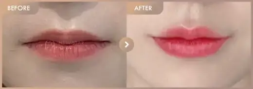 Lip fillers: before-and-after comparison at Newstar Clinic