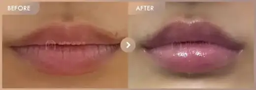Lip fillers: before-and-after comparison at Newstar Clinic