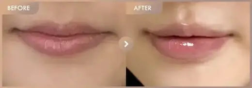 Lip filler: before-and-after comparison at Newstar Clinic