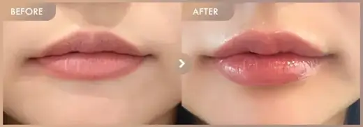 Lip filler: before-and-after comparison at Newstar Clinic