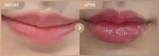 Lip filler: before-and-after comparison at Newstar Clinic