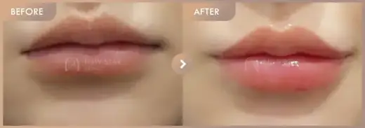Lip fillers: before-and-after comparison at Newstar Clinic