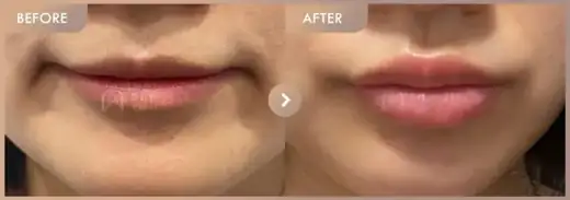 Lip filler: before-and-after comparison at Newstar Clinic