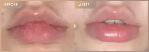 Lip filler: before-and-after comparison at Newstar Clinic