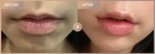 Lip filler: before-and-after comparison at Newstar Clinic