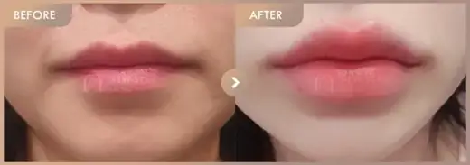 Lip filler: before-and-after comparison at Newstar Clinic