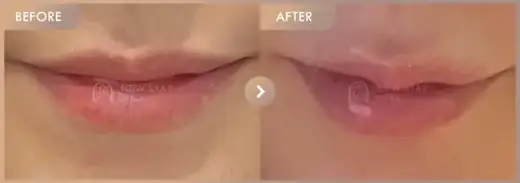 Lip fillers: before-and-after comparison at Newstar Clinic
