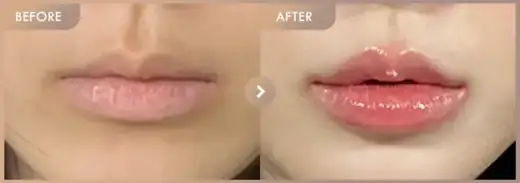 Lip filler: before-and-after comparison at Newstar Clinic