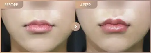 Lip filler: before-and-after comparison at Newstar Clinic