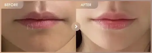 Lip fillers: before-and-after comparison at Newstar Clinic