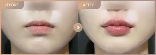 Lip filler: before-and-after comparison at Newstar Clinic