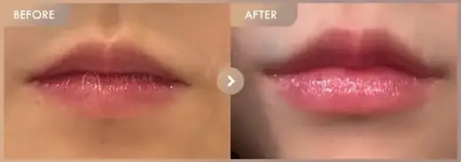 Lip fillers: before-and-after comparison at Newstar Clinic