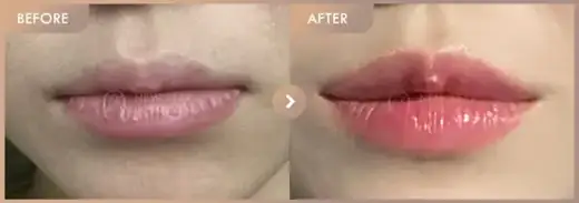 Lip filler: before-and-after comparison at Newstar Clinic