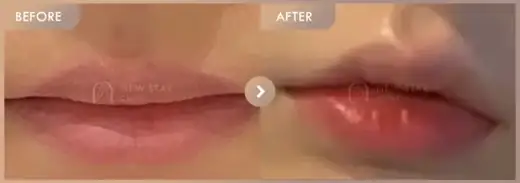 Lip filler: before-and-after comparison at Newstar Clinic