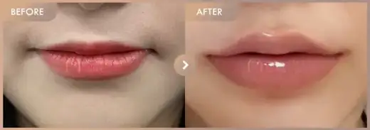 Lip filler: before-and-after comparison at Newstar Clinic