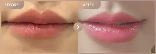 Lip filler: before-and-after comparison at Newstar Clinic