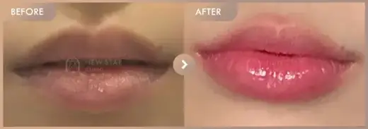 Lip filler: before-and-after comparison at Newstar Clinic