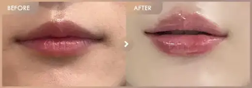 Lip filler: before-and-after comparison at Newstar Clinic