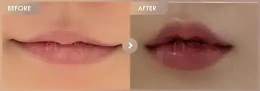 Lip filler: before-and-after comparison at Newstar Clinic