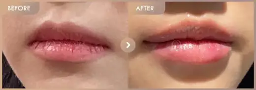Lip fillers: before-and-after comparison at Newstar Clinic