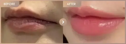 Lip fillers: before-and-after comparison at Newstar Clinic