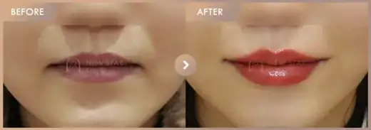 Lip filler: before-and-after comparison at Newstar Clinic
