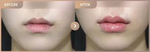 Lip filler: before-and-after comparison at Newstar Clinic