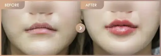 Lip filler: before-and-after comparison at Newstar Clinic