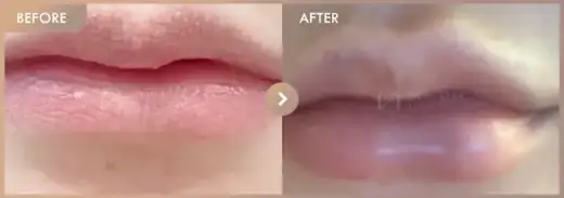 Lip filler: before-and-after comparison at Newstar Clinic