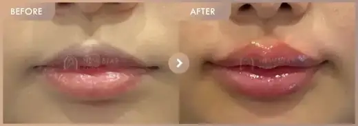 Lip fillers: before-and-after comparison at Newstar Clinic
