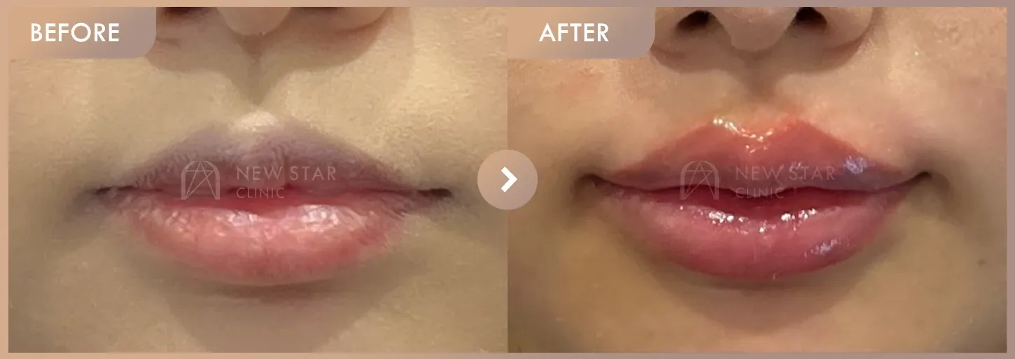 Lip fillers before-and-after photos at Newstar Clinic