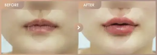 Lip filler: before-and-after comparison at Newstar Clinic