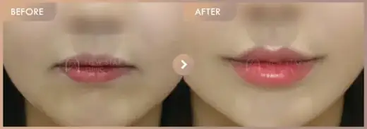 Lip filler: before-and-after comparison at Newstar Clinic