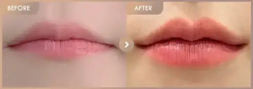 Lip fillers: before-and-after comparison at Newstar Clinic