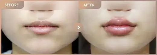 Lip filler: before-and-after comparison at Newstar Clinic
