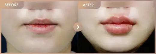 Lip filler: before-and-after comparison at Newstar Clinic