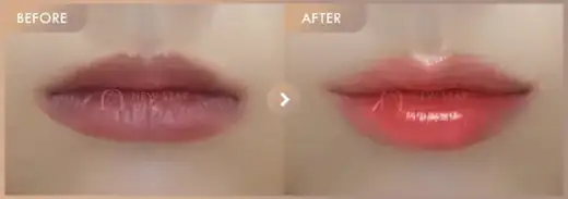 Lip filler: before-and-after comparison at Newstar Clinic