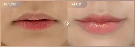 Lip filler: before-and-after comparison at Newstar Clinic
