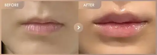 Lip fillers: before-and-after comparison at Newstar Clinic