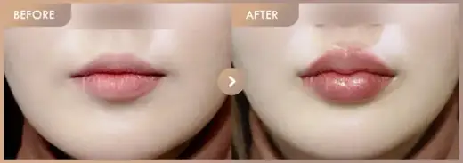 Lip filler: before-and-after comparison at Newstar Clinic