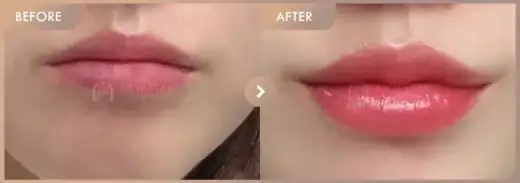 Lip filler: before-and-after comparison at Newstar Clinic