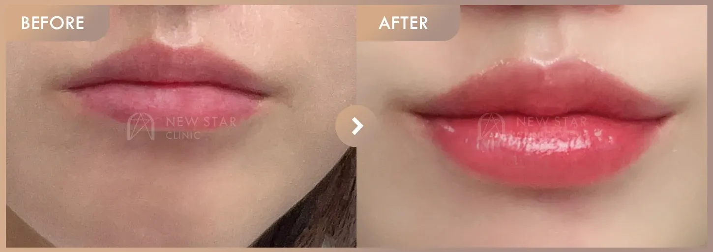 Lip filler before-and-after photos at Newstar Clinic