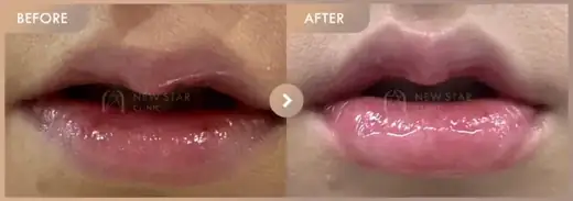 Lip fillers: before-and-after comparison at Newstar Clinic