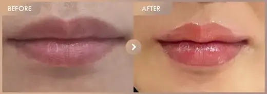 Lip fillers: before-and-after comparison at Newstar Clinic
