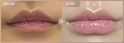 Lip filler: before-and-after comparison at Newstar Clinic
