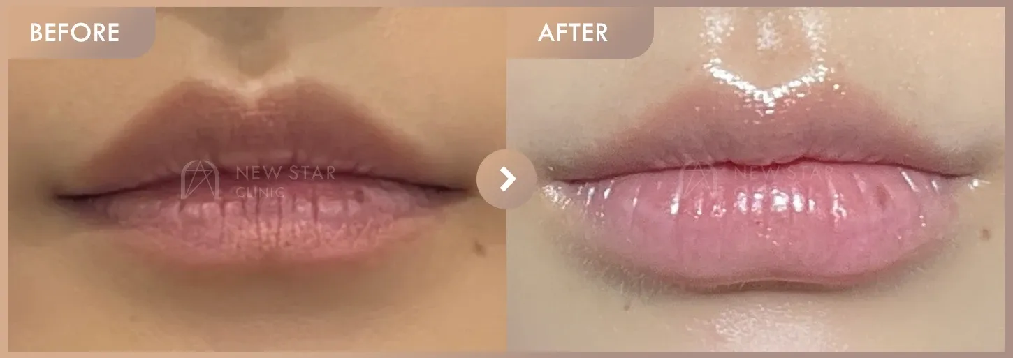 Lip filler before-and-after photos at Newstar Clinic