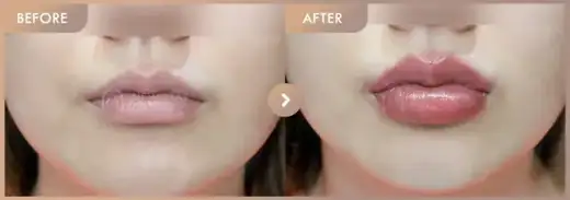Lip filler: before-and-after comparison at Newstar Clinic