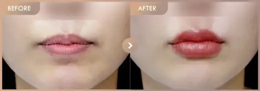 Lip filler: before-and-after comparison at Newstar Clinic